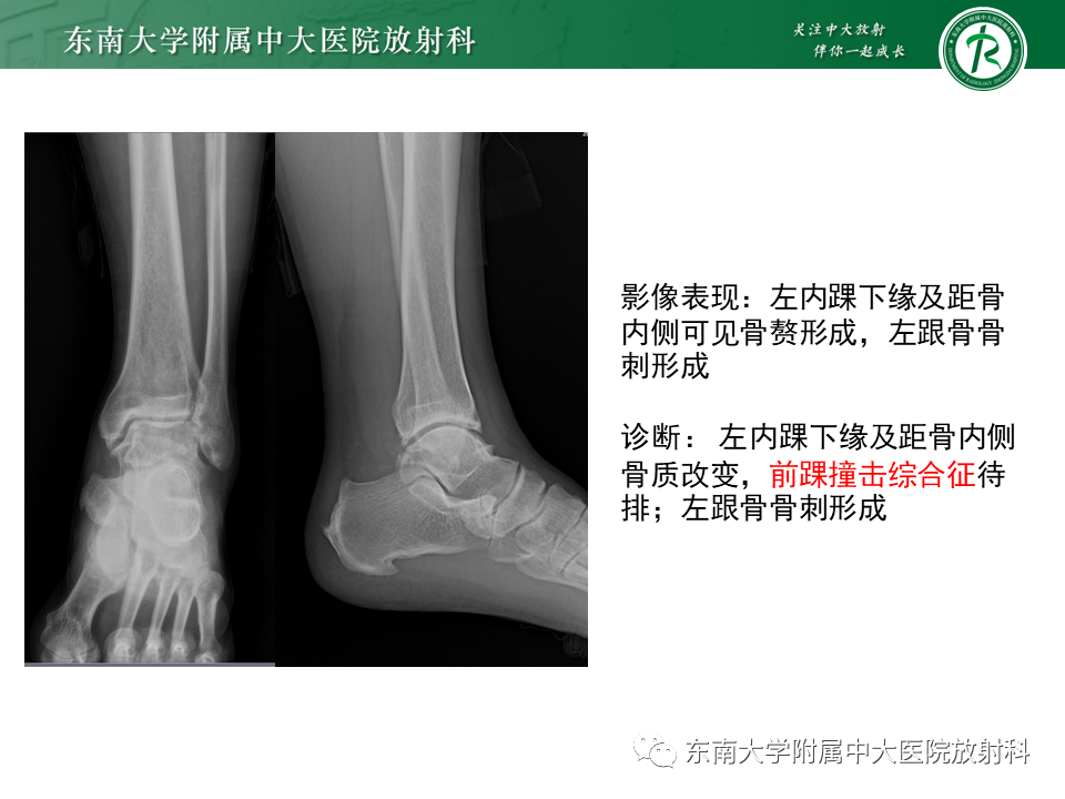 影像PPT - 【PPT】踝关节撞击综合征-3