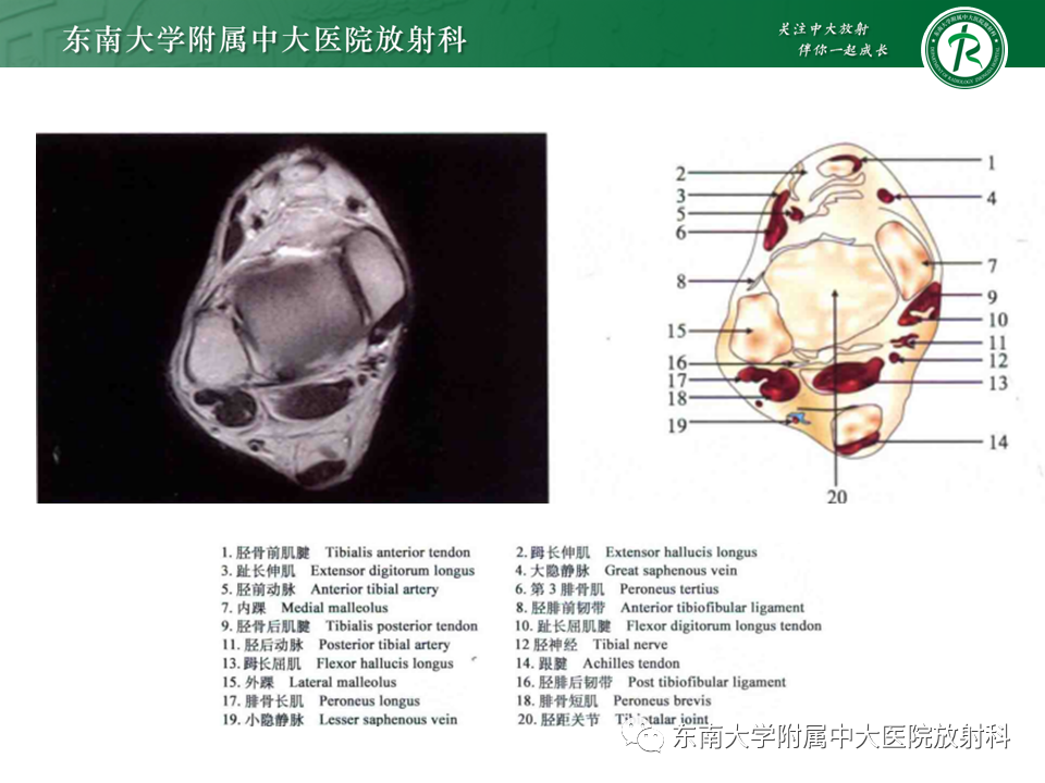 影像PPT - 【PPT】踝关节撞击综合征-7