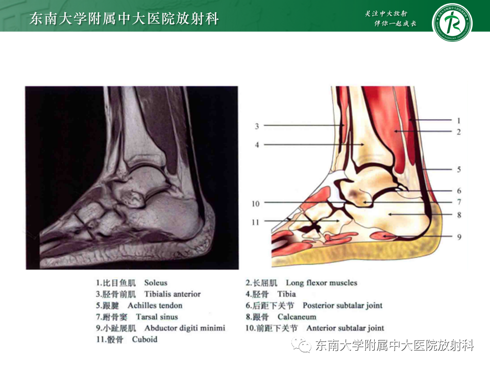 影像PPT - 【PPT】踝关节撞击综合征-8