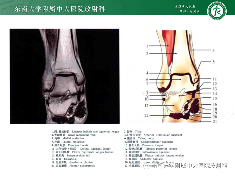 影像PPT - 【PPT】踝关节撞击综合征-9