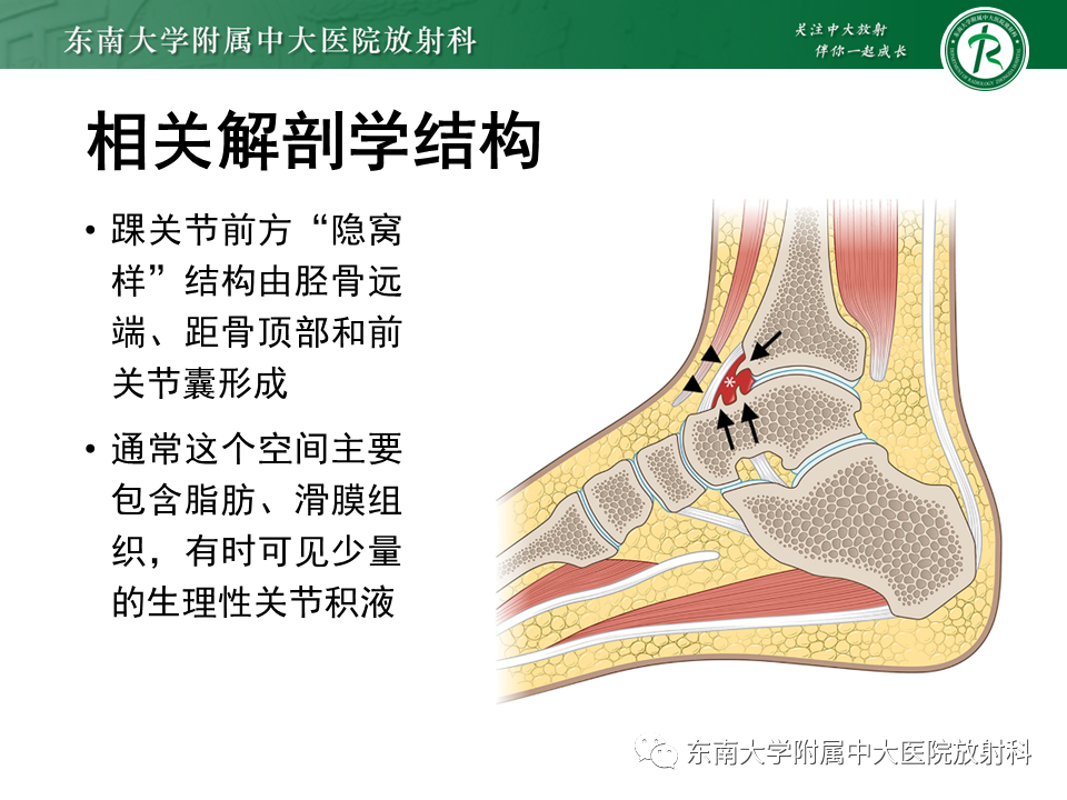 影像PPT - 【PPT】踝关节撞击综合征-11