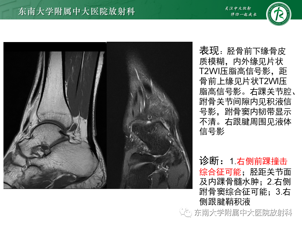 影像PPT - 【PPT】踝关节撞击综合征-15
