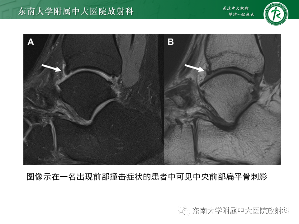 影像PPT - 【PPT】踝关节撞击综合征-17