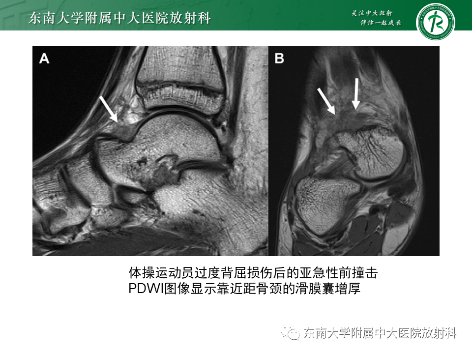 影像PPT - 【PPT】踝关节撞击综合征-18