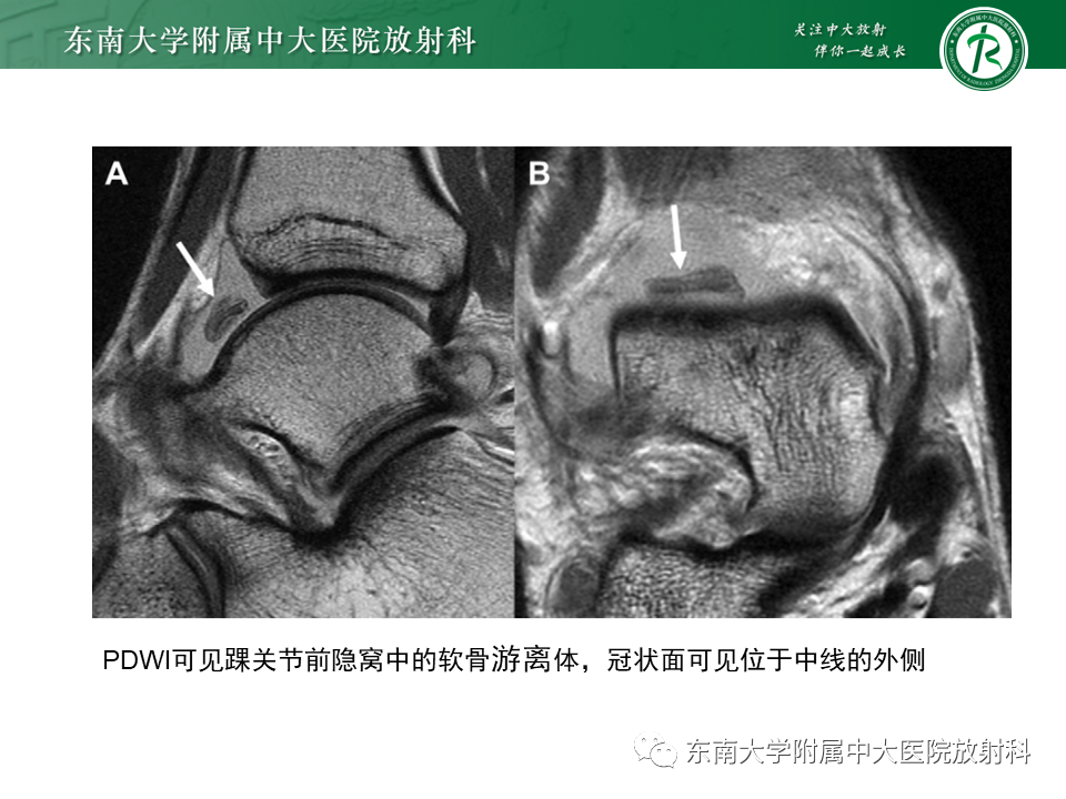 影像PPT - 【PPT】踝关节撞击综合征-19