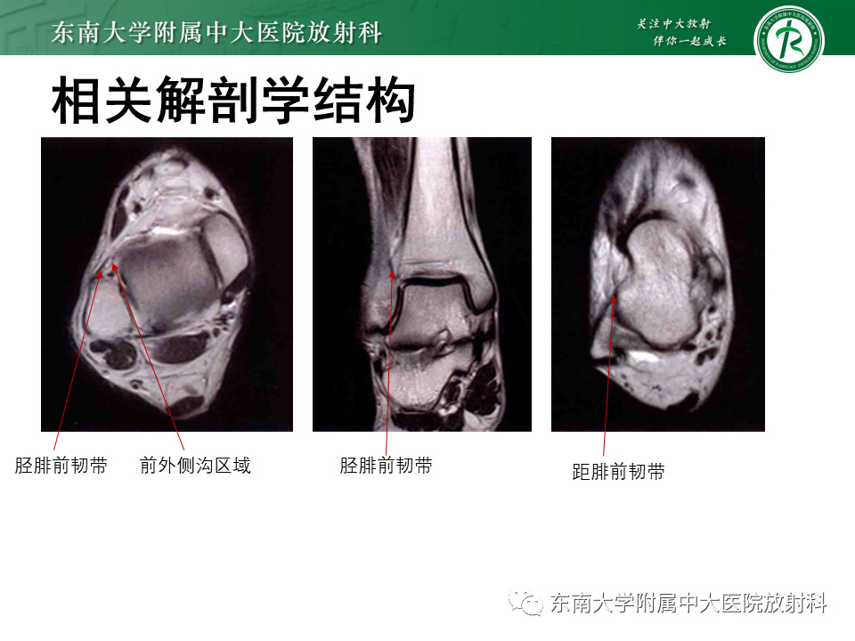 影像PPT - 【PPT】踝关节撞击综合征-22