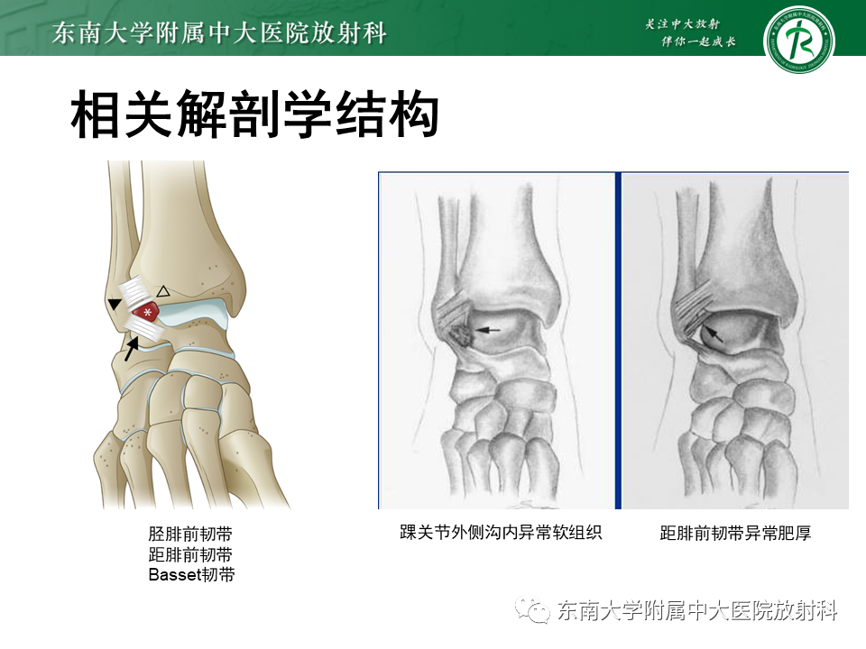 影像PPT - 【PPT】踝关节撞击综合征-21
