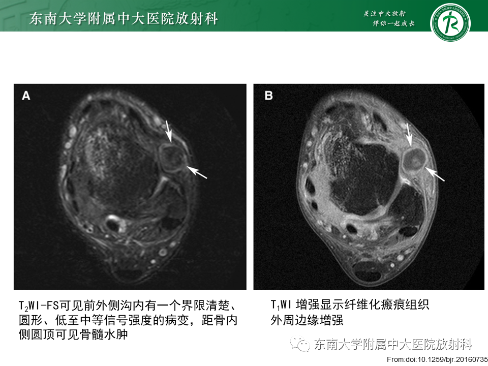 影像PPT - 【PPT】踝关节撞击综合征-25