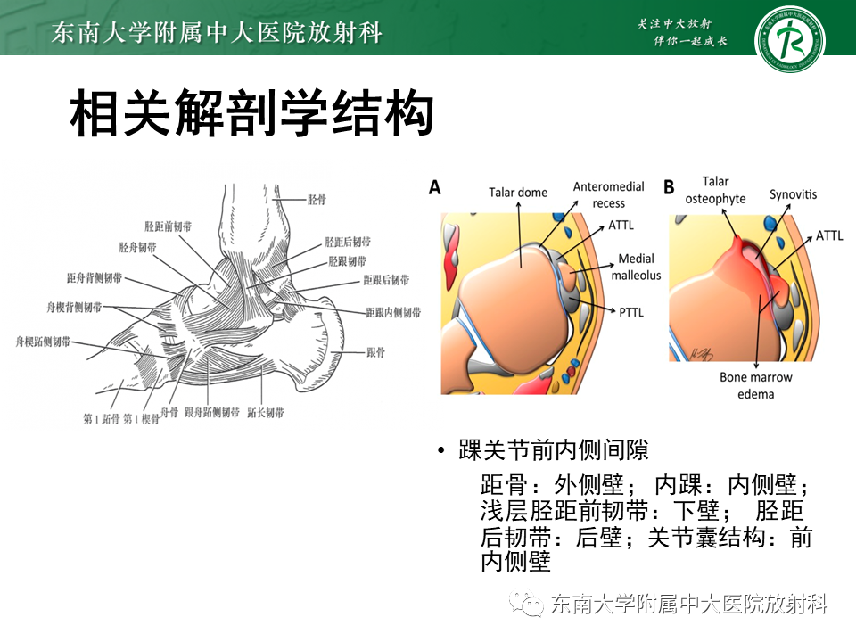 影像PPT - 【PPT】踝关节撞击综合征-27