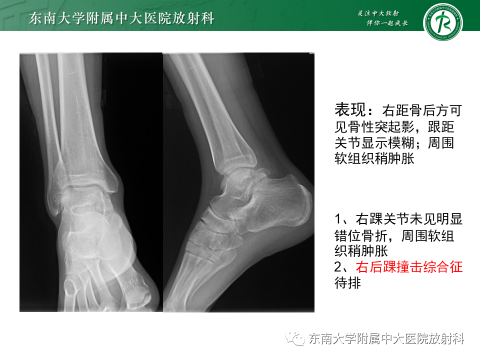 影像PPT - 【PPT】踝关节撞击综合征-32