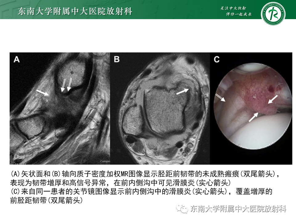 影像PPT - 【PPT】踝关节撞击综合征-30