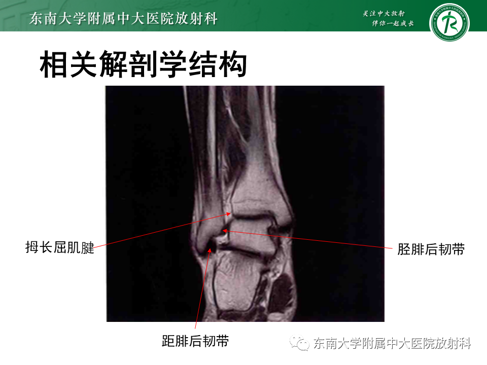 影像PPT - 【PPT】踝关节撞击综合征-35