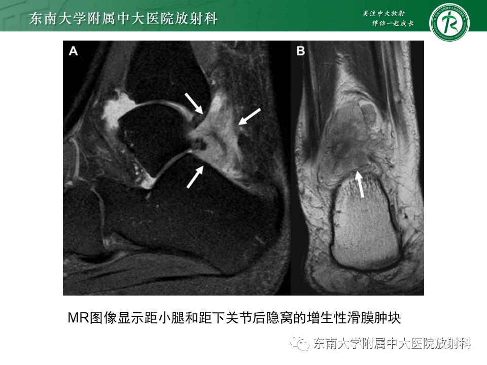 影像PPT - 【PPT】踝关节撞击综合征-38