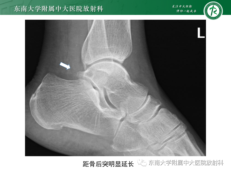 影像PPT - 【PPT】踝关节撞击综合征-39