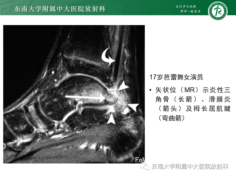 影像PPT - 【PPT】踝关节撞击综合征-40