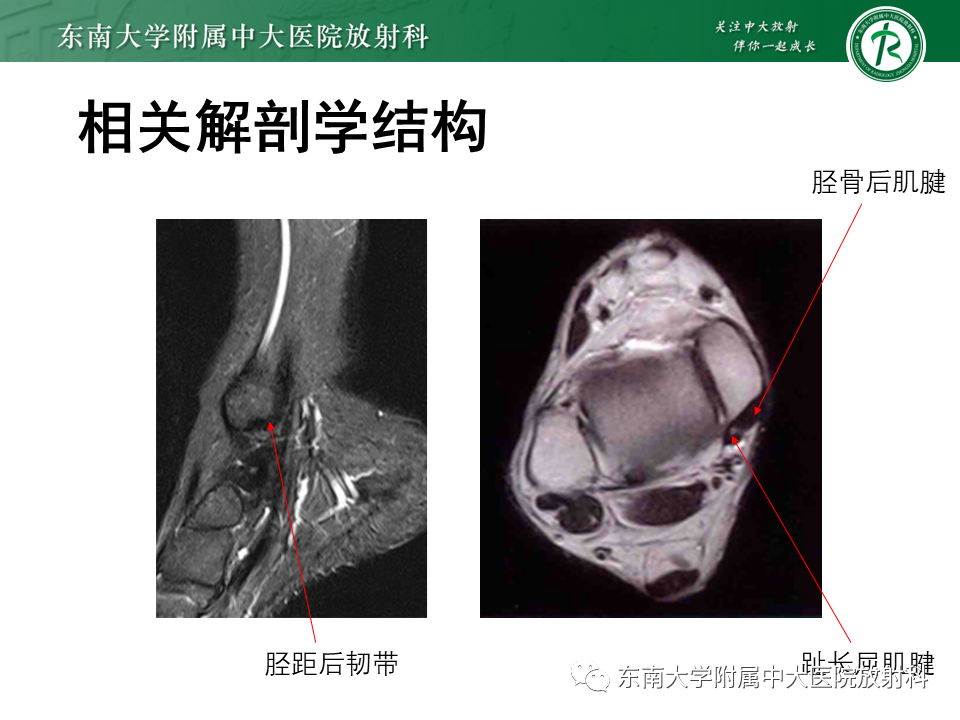 影像PPT - 【PPT】踝关节撞击综合征-43