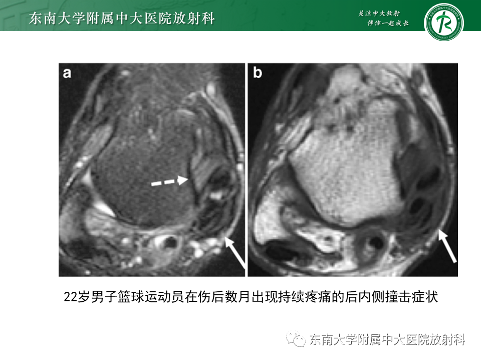 影像PPT - 【PPT】踝关节撞击综合征-45