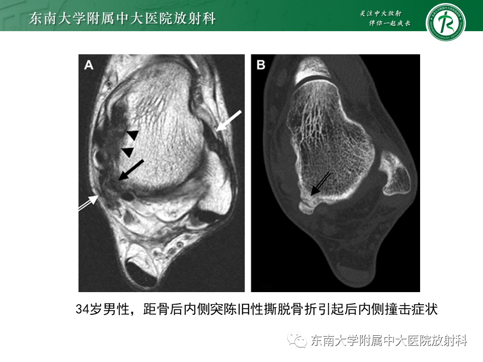 影像PPT - 【PPT】踝关节撞击综合征-46