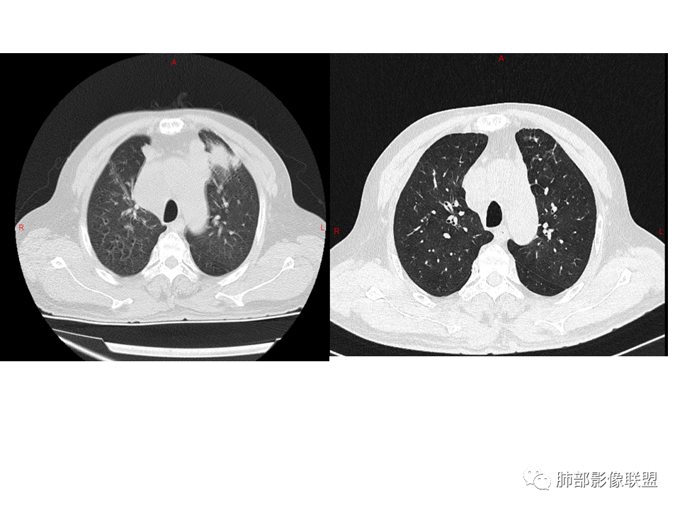 影像PPT - 【病例】鼻咽癌患者肺内出现多发肿块、结节就一定是转移瘤吗？-34