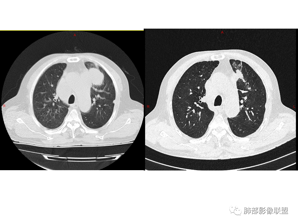 影像PPT - 【病例】鼻咽癌患者肺内出现多发肿块、结节就一定是转移瘤吗？-35
