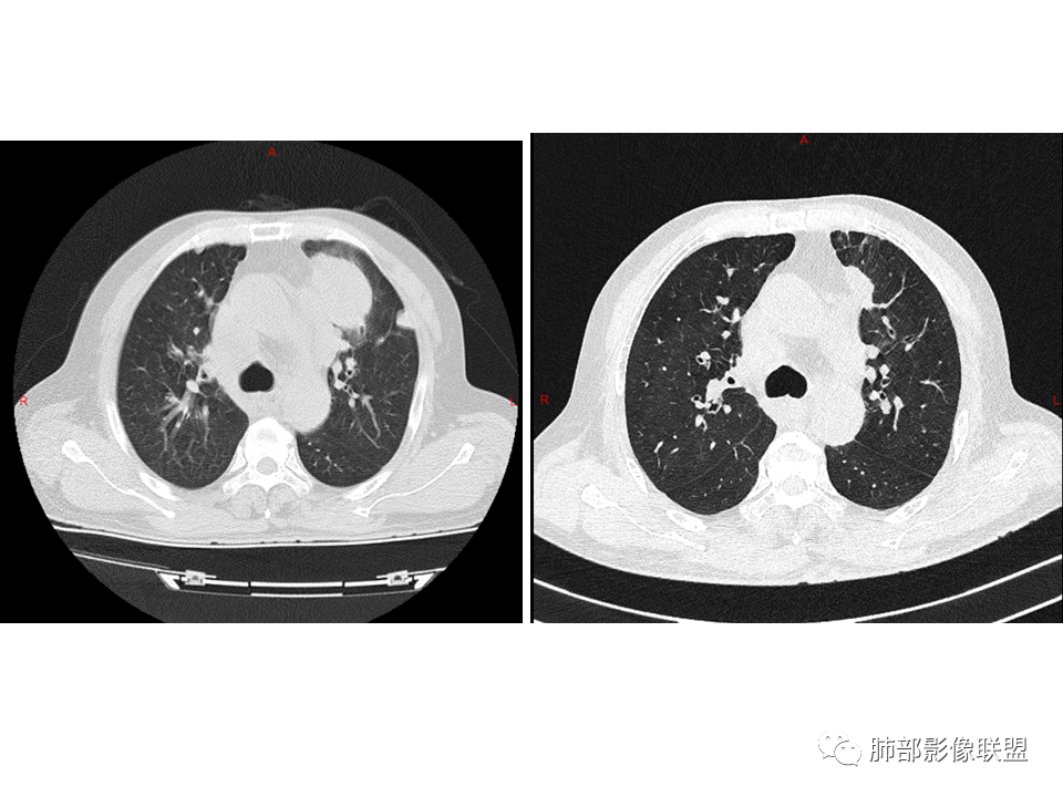 影像PPT - 【病例】鼻咽癌患者肺内出现多发肿块、结节就一定是转移瘤吗？-36