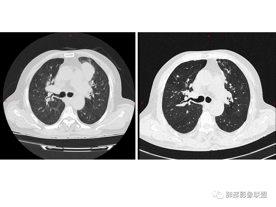 影像PPT - 【病例】鼻咽癌患者肺内出现多发肿块、结节就一定是转移瘤吗？-37