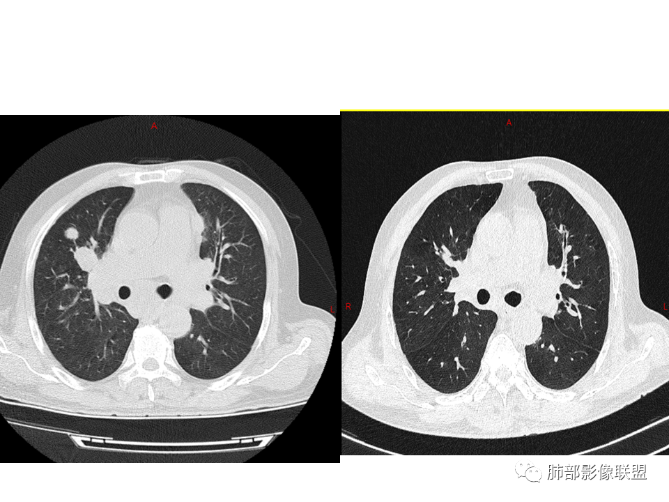影像PPT - 【病例】鼻咽癌患者肺内出现多发肿块、结节就一定是转移瘤吗？-38