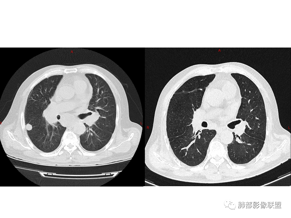影像PPT - 【病例】鼻咽癌患者肺内出现多发肿块、结节就一定是转移瘤吗？-39