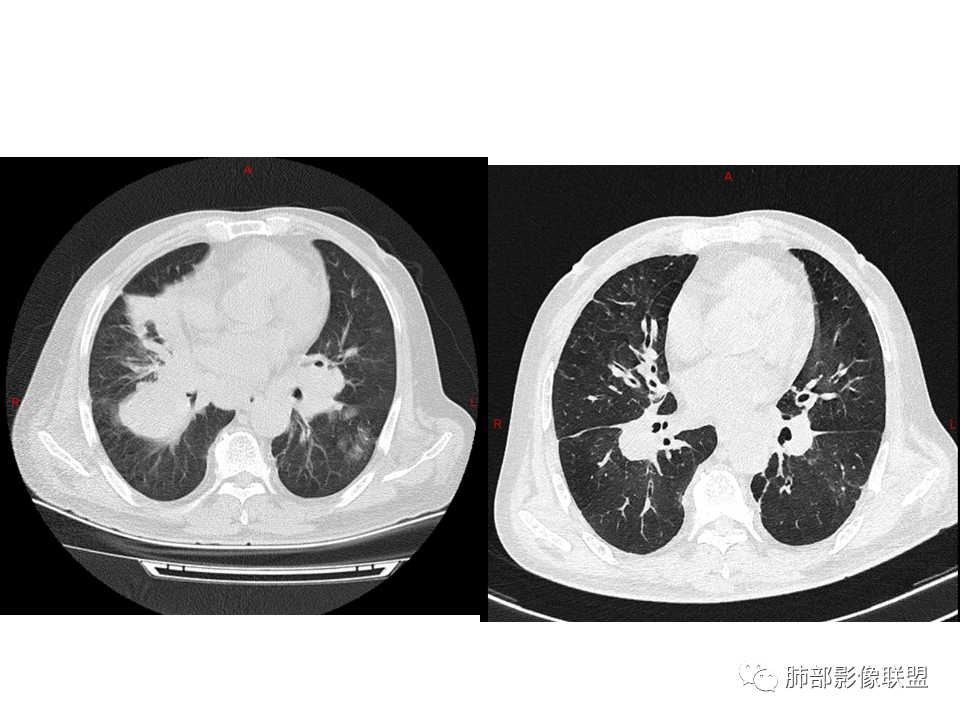 影像PPT - 【病例】鼻咽癌患者肺内出现多发肿块、结节就一定是转移瘤吗？-40