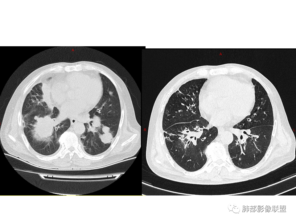 影像PPT - 【病例】鼻咽癌患者肺内出现多发肿块、结节就一定是转移瘤吗？-41