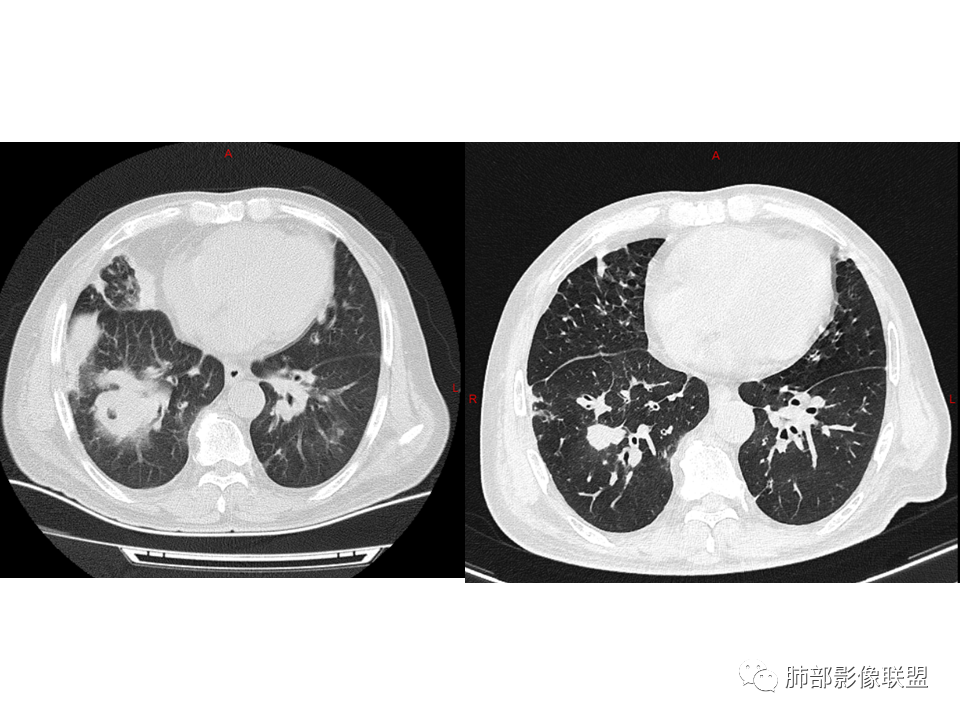 影像PPT - 【病例】鼻咽癌患者肺内出现多发肿块、结节就一定是转移瘤吗？-42
