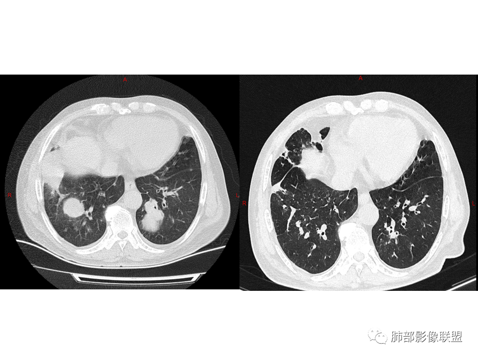 影像PPT - 【病例】鼻咽癌患者肺内出现多发肿块、结节就一定是转移瘤吗？-43
