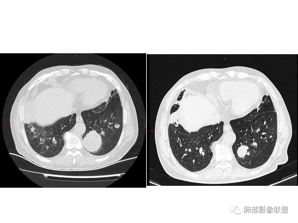 影像PPT - 【病例】鼻咽癌患者肺内出现多发肿块、结节就一定是转移瘤吗？-44