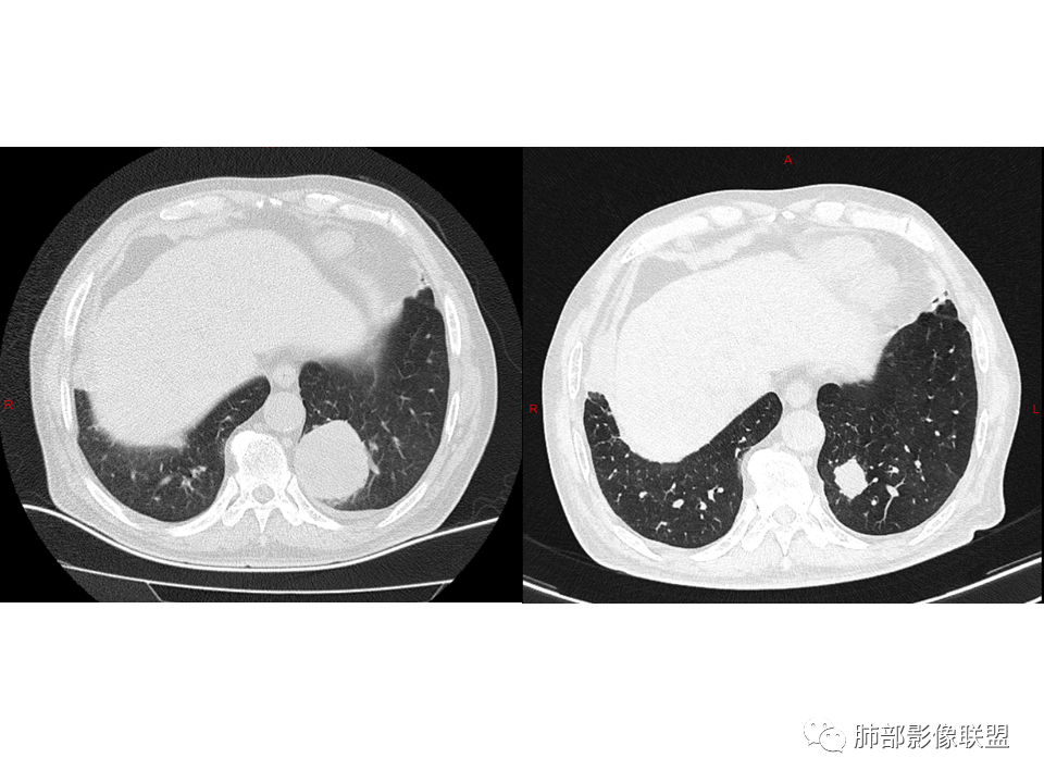 影像PPT - 【病例】鼻咽癌患者肺内出现多发肿块、结节就一定是转移瘤吗？-45