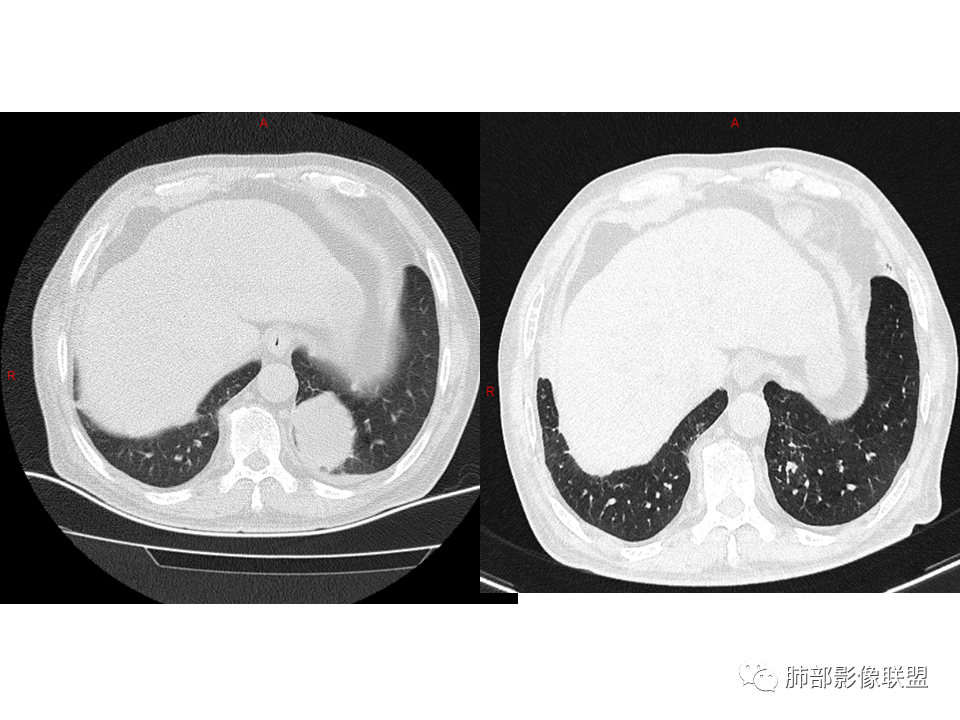 影像PPT - 【病例】鼻咽癌患者肺内出现多发肿块、结节就一定是转移瘤吗？-46