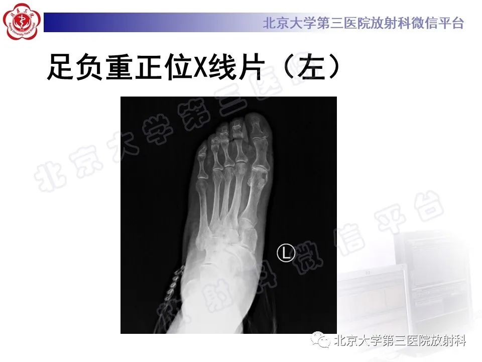 影像PPT - 【PPT】足舟骨缺血坏死-3