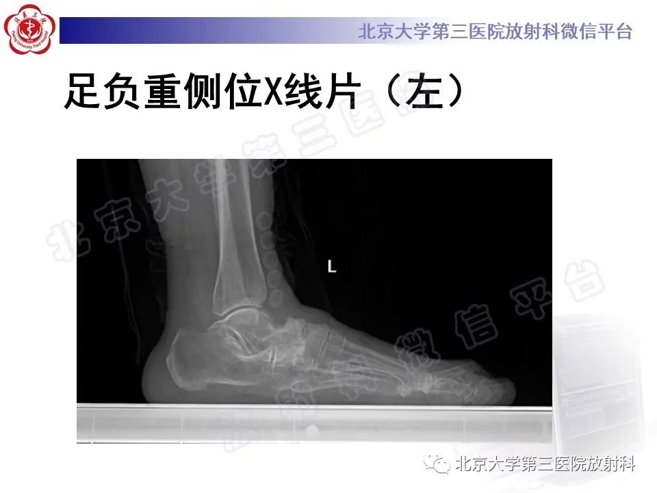 影像PPT - 【PPT】足舟骨缺血坏死-4
