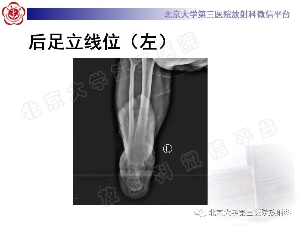 影像PPT - 【PPT】足舟骨缺血坏死-5