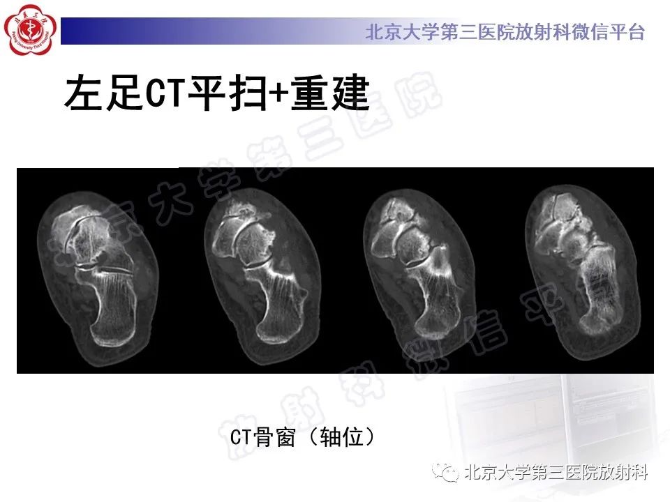 影像PPT - 【PPT】足舟骨缺血坏死-6