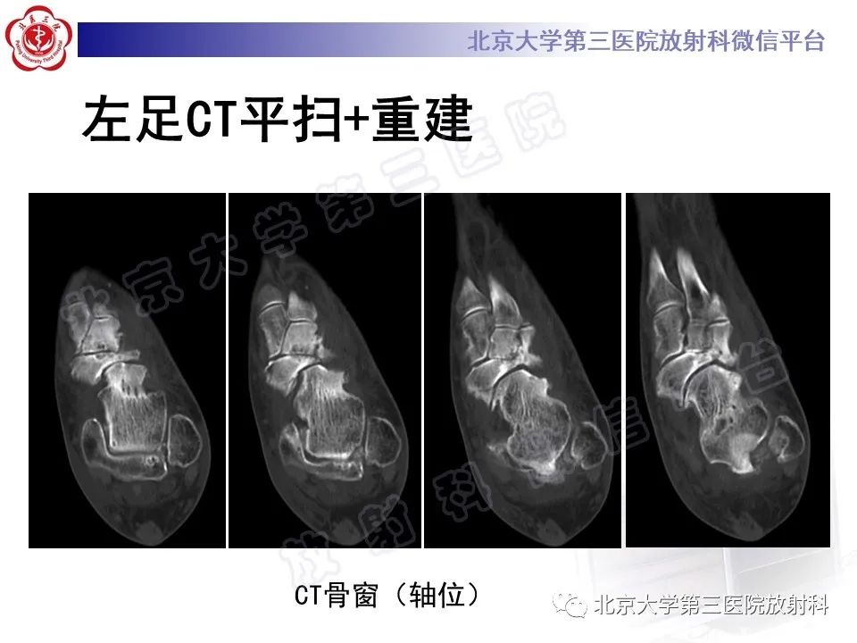 影像PPT - 【PPT】足舟骨缺血坏死-7