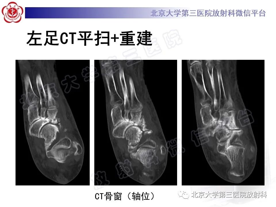影像PPT - 【PPT】足舟骨缺血坏死-8