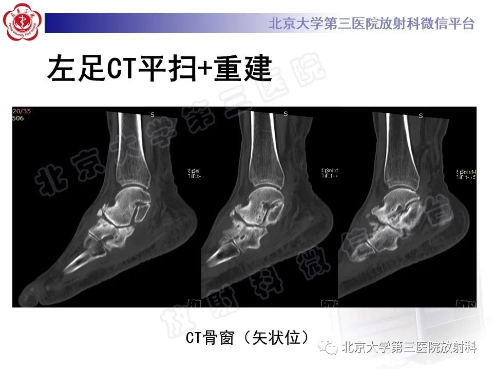 影像PPT - 【PPT】足舟骨缺血坏死-10