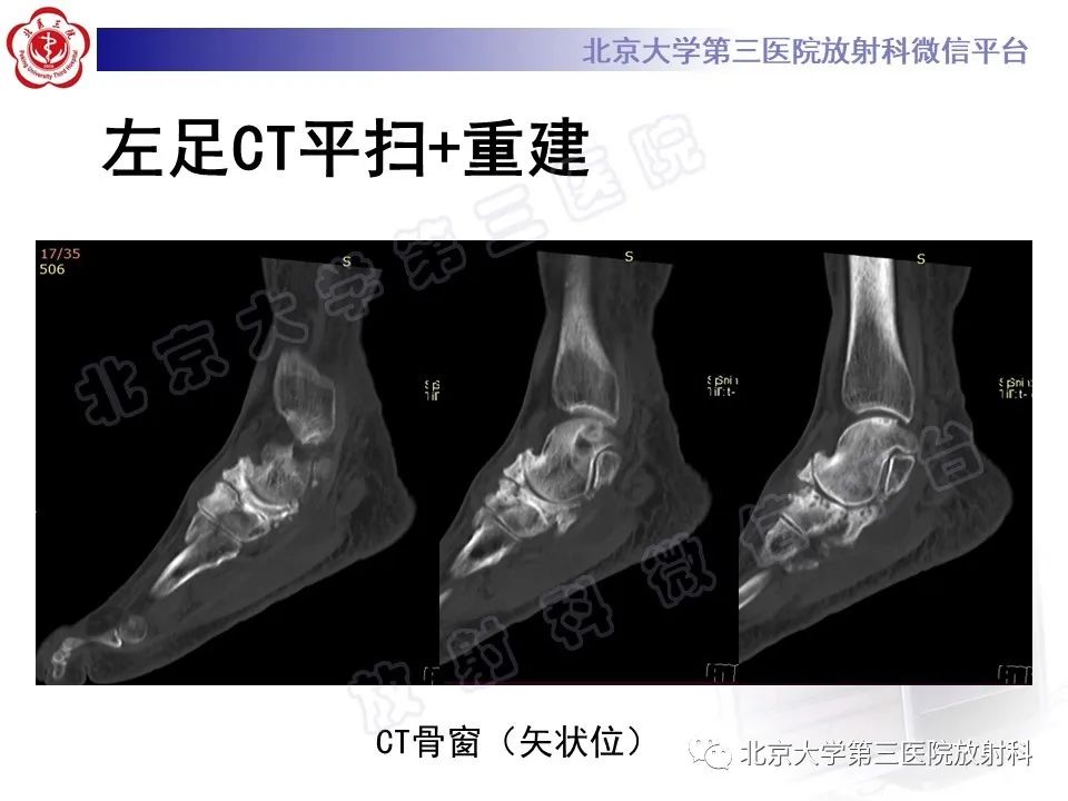 影像PPT - 【PPT】足舟骨缺血坏死-9