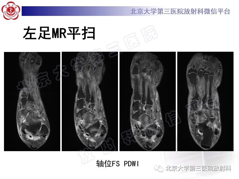 影像PPT - 【PPT】足舟骨缺血坏死-11