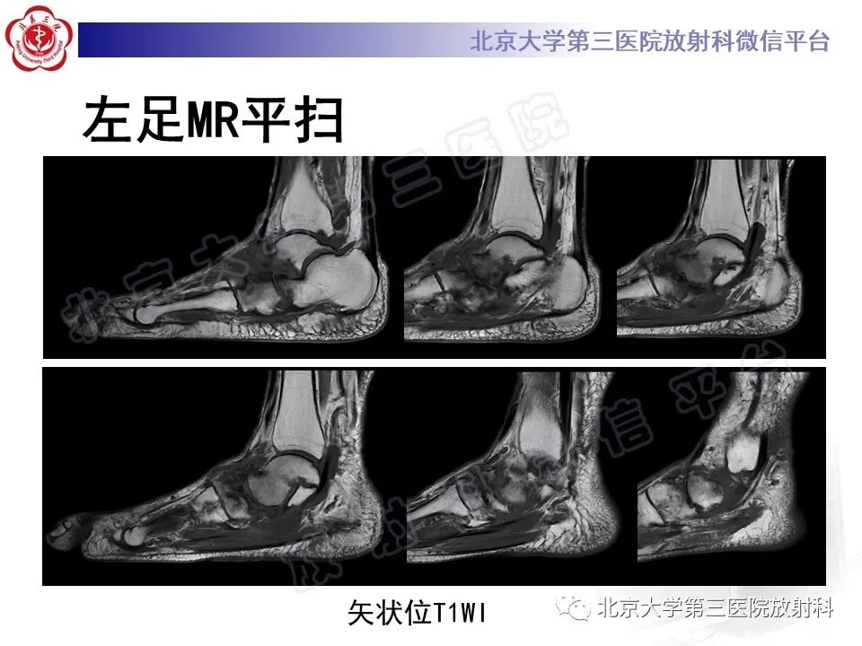影像PPT - 【PPT】足舟骨缺血坏死-12