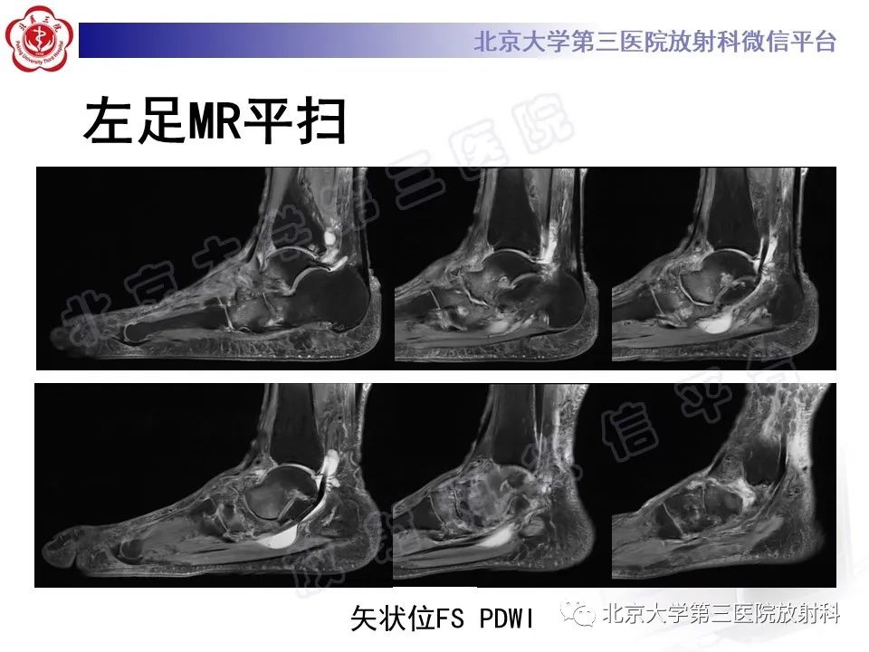 影像PPT - 【PPT】足舟骨缺血坏死-13