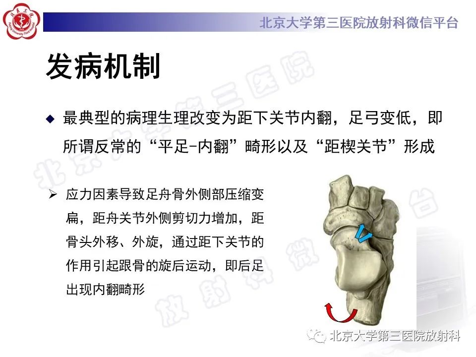 影像PPT - 【PPT】足舟骨缺血坏死-21