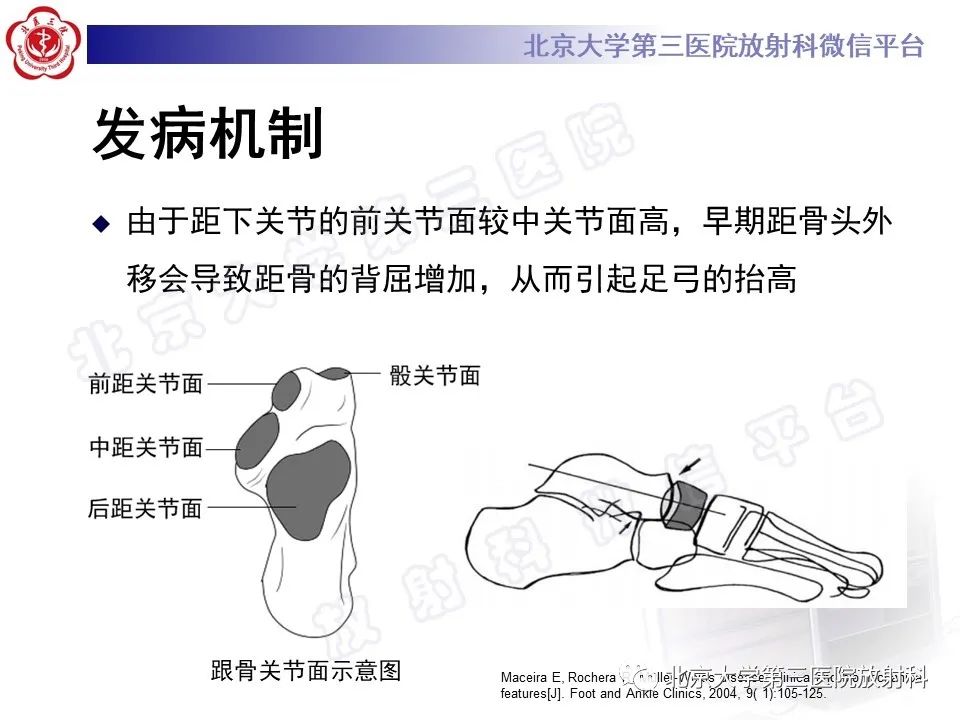 影像PPT - 【PPT】足舟骨缺血坏死-22
