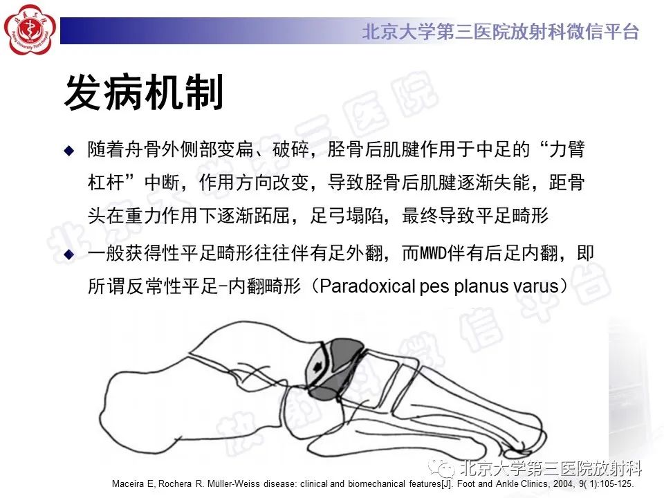 影像PPT - 【PPT】足舟骨缺血坏死-23
