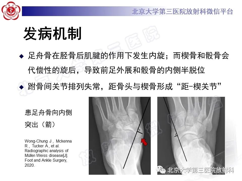 影像PPT - 【PPT】足舟骨缺血坏死-24